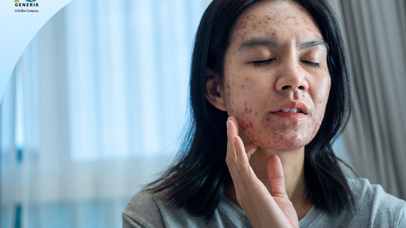 Kenapa Alergi Baru Muncul Saat Dewasa?